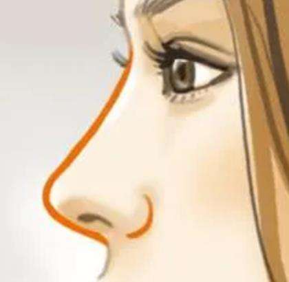 鼻基底填充的方法有哪些？哪些情况适合鼻基底填充?